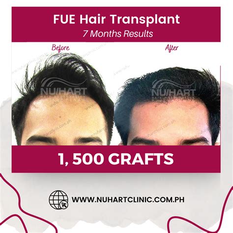Nu/Hart Hair Restoration Philippines .